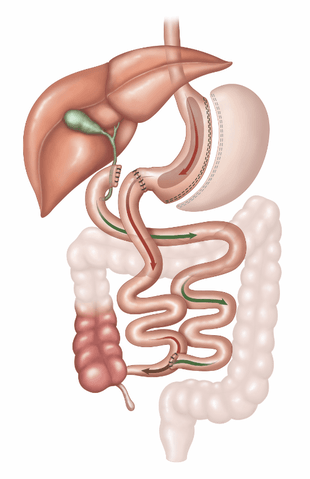 Duodenal Switch - Bariatric Fusion