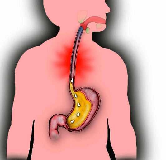 Acid Reflux Or GERD After Bariatric Surgery - 3 Tips! - Bariatric Fusion
