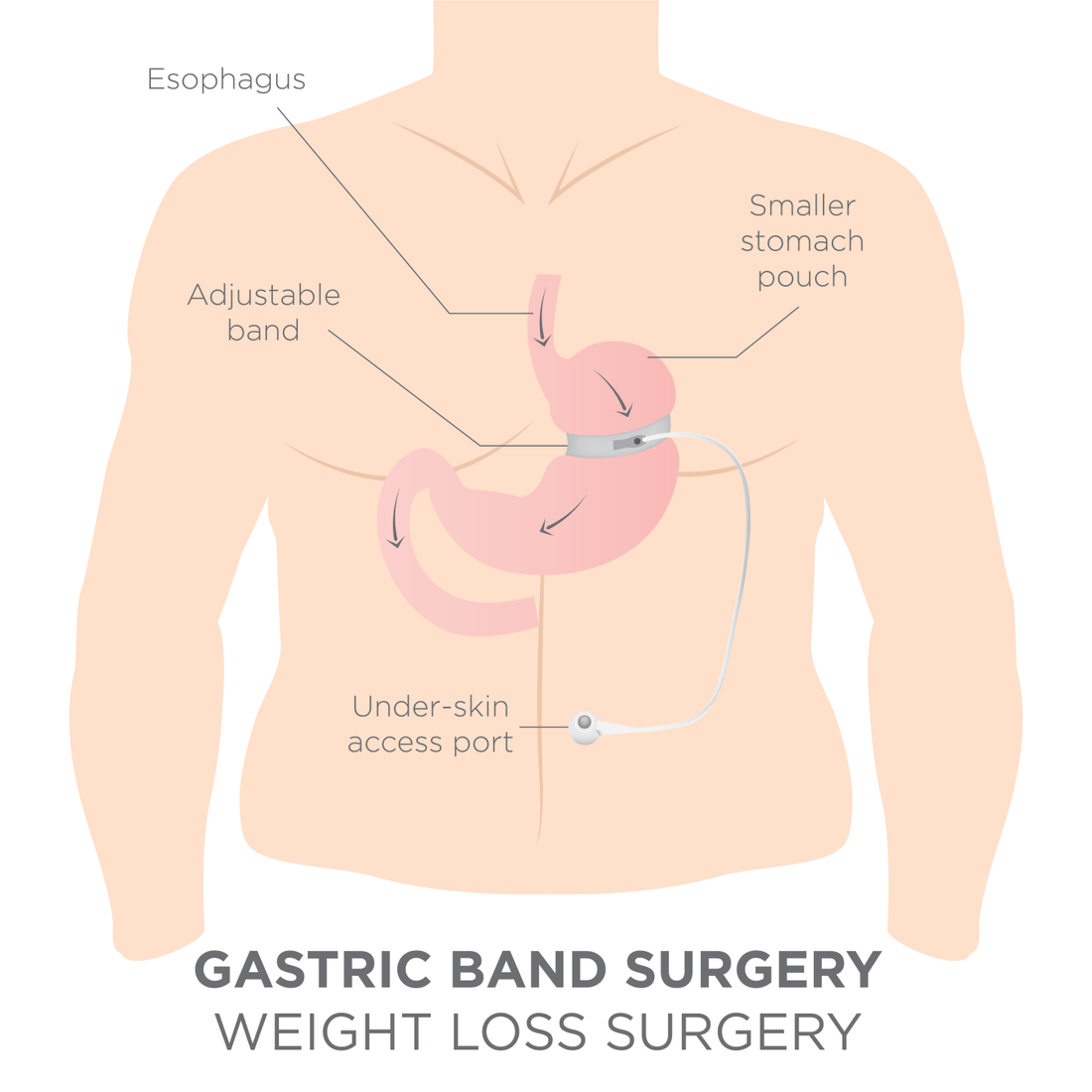 Gastric Bands Side Effects - Bariatric Fusion