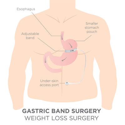 Gastric Bands Side Effects