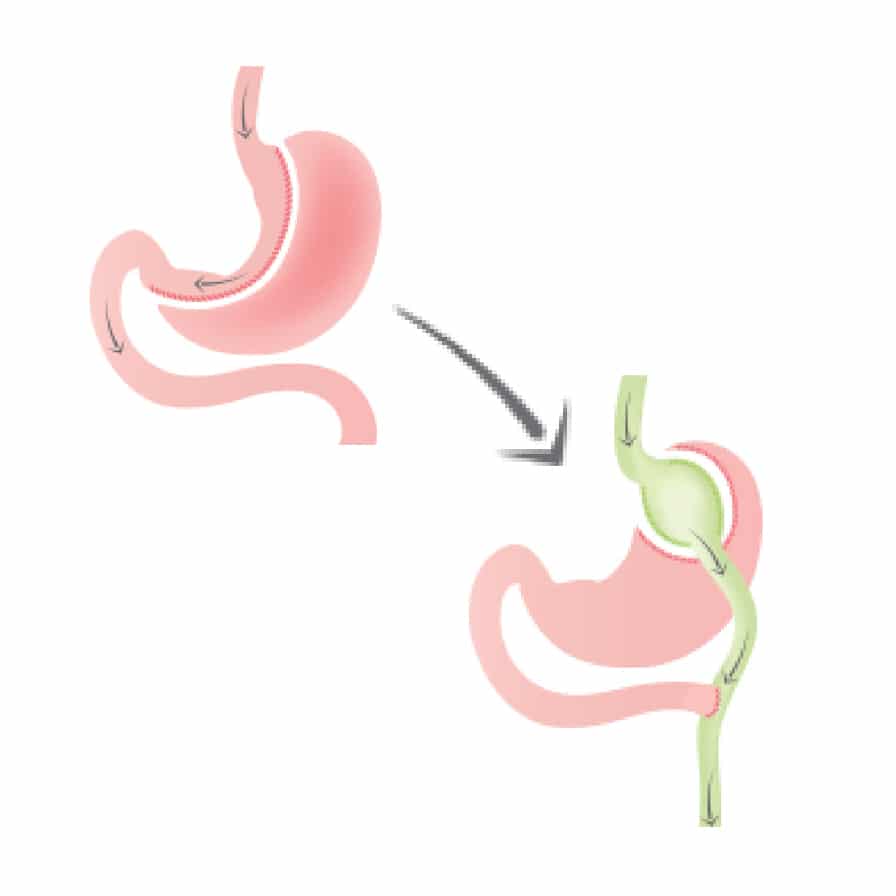Gastric Bypass Revision - Bariatric Fusion
