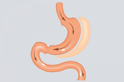 Gastric Sleeve - Bariatric Fusion